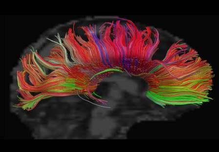 Colorful Diffusion Tensor Image of the brain